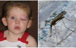 Какво да направите, ако детето има подпухнало око след ухапване от комари