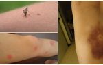 Защо кръвотеченията остават след ухапване от комари?
