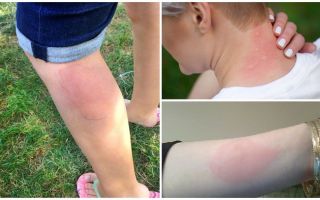 Лечение на алергии към ухапвания от комари при възрастни и деца