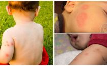 Средства за деца след ухапване от комари