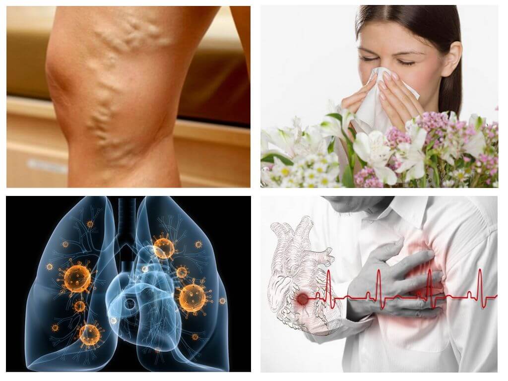 Алергия, сърдечни заболявания, туберкулоза