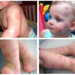 Алергия към ухапвания от бъбреци при деца