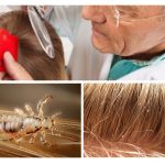 Изследване на косата за педикулоза