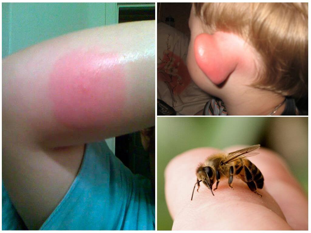 Ухапване от пчела
